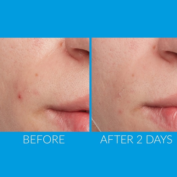 ✨Kate Somerville ERADIKATE® ACNE TREATMENT - Picture 2 of 11